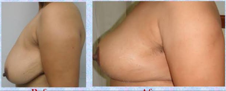 Breast lift surgery in delhi