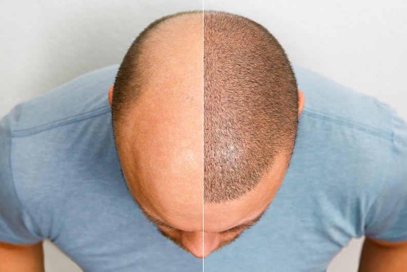 Hair Transplant Surgery Myths vs. Facts: Debunking Common Misconceptions