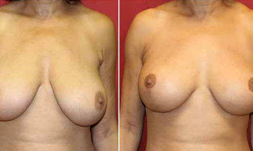 Breast Lift Surgery in Delhi