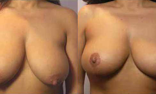 Breast Reduction Surgery in  Delhi