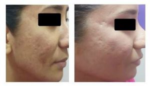 Acne Scar Removal Before After