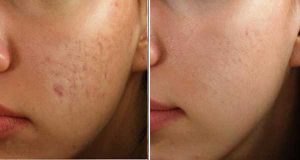 Acne Scar Removal Before After