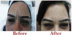 Botox Treatment Before After