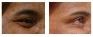 Botox Treatment Before After