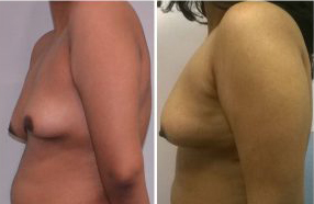 Breast Augmentation By Fat Grafting Before After