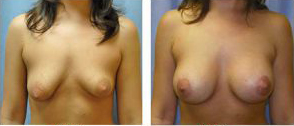 Breast Implant  Before After