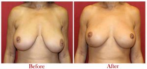 Breast Lift Before After