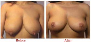 Breast Reduction Before After