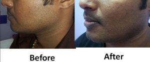 Chin Reshaping Before After