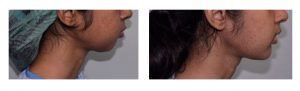 Chin Reshaping Before After