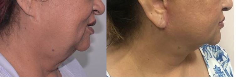 Face Lift Before After