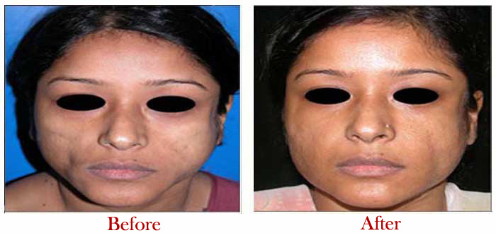 Fat Injection Before After