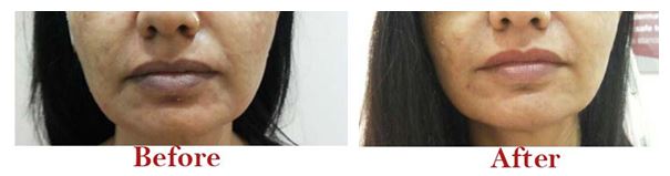 Fillers Treatment Before After