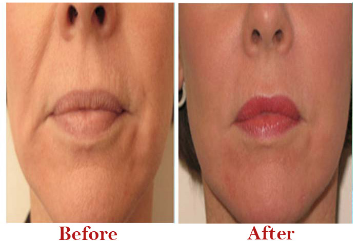 Fillers Treatment Before After