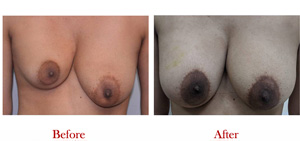 Breast Augmentation By Fat Grafting