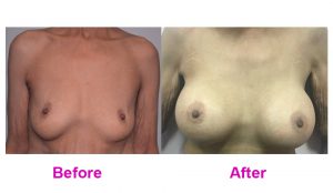 Breast Implant Before After