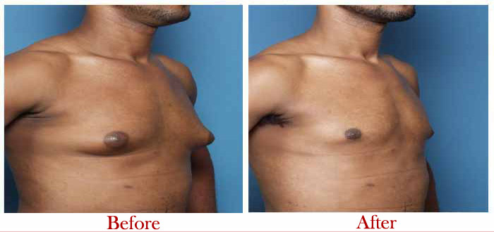 Male Breast Reduction Before After