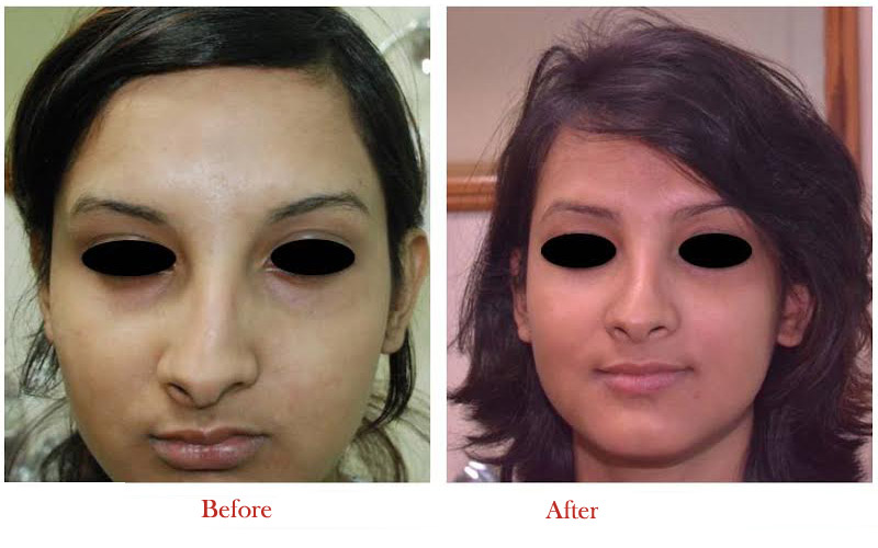 Nose Reshaping Before After