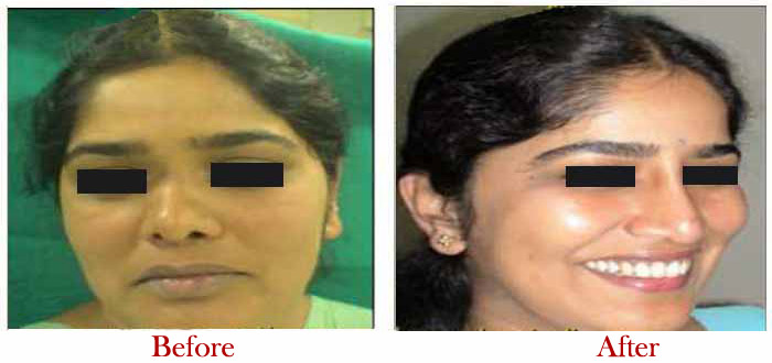 Nose Reshaping Before After