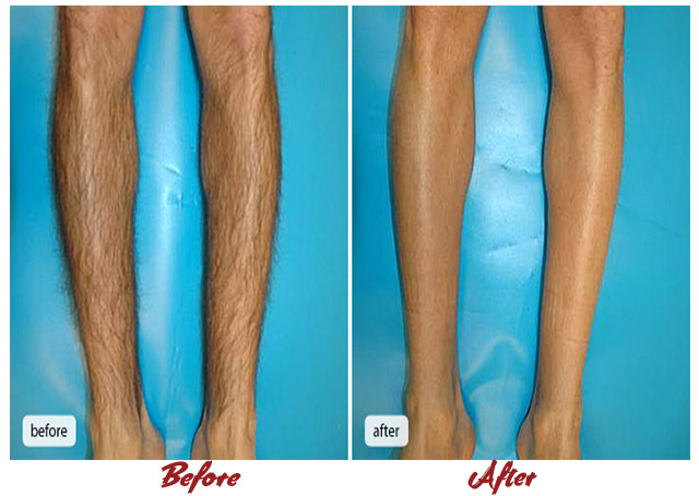 Pain-Free Hair Removal Before After