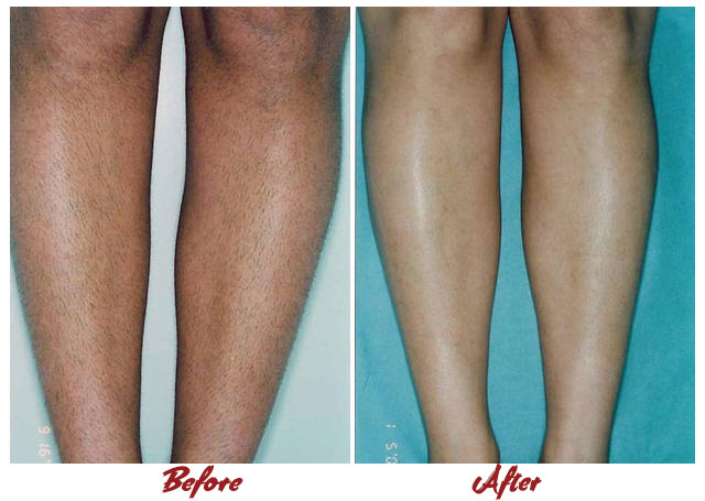 Pain-Free Hair Removal Before After