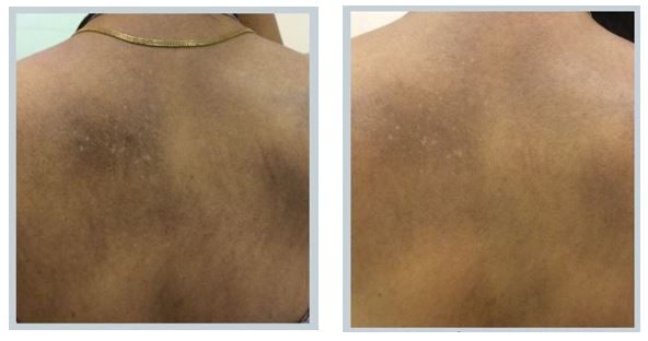 Pigmentation Before After