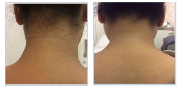 Pigmentation Before After