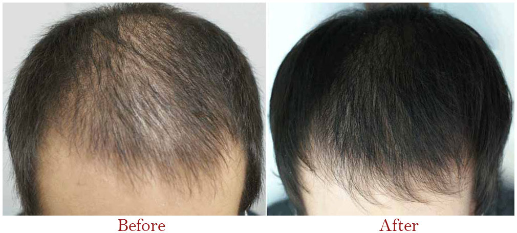 PRP Treatment Before After