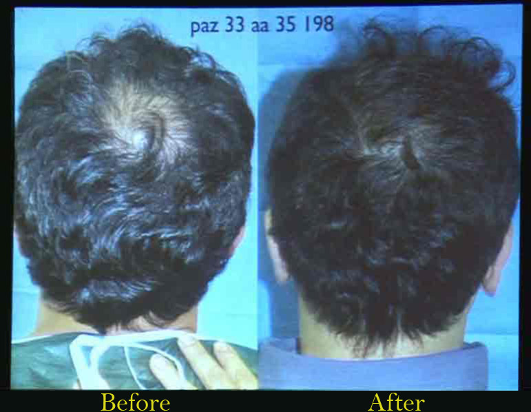 PRP Treatment Before After