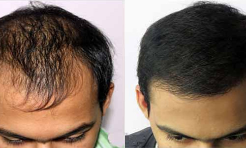 Hair transplant in delhi
